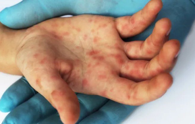 Sarampo: Sintomas e Como se Proteger em Alagoas