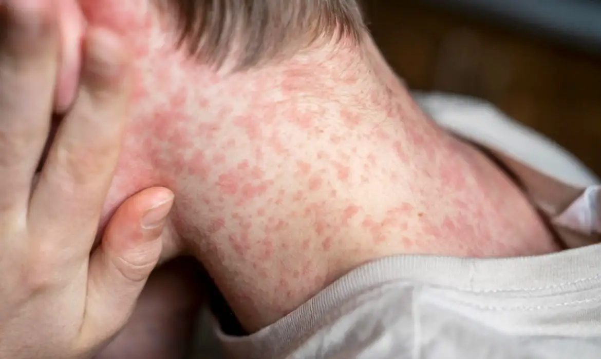 Riscos do sarampo aumentam com fluxo turístico